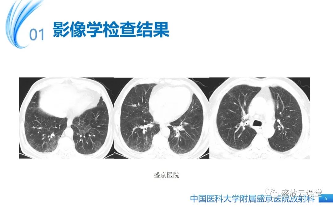 影像PPT - 【病例】弥漫性气管狭窄1例CT影像-5