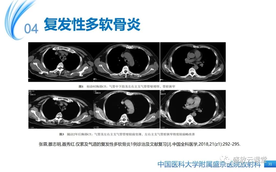 影像PPT - 【病例】弥漫性气管狭窄1例CT影像-31