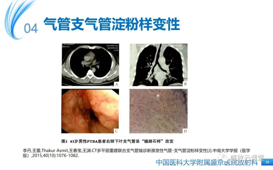 影像PPT - 【病例】弥漫性气管狭窄1例CT影像-38