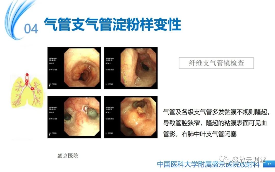 影像PPT - 【病例】弥漫性气管狭窄1例CT影像-37