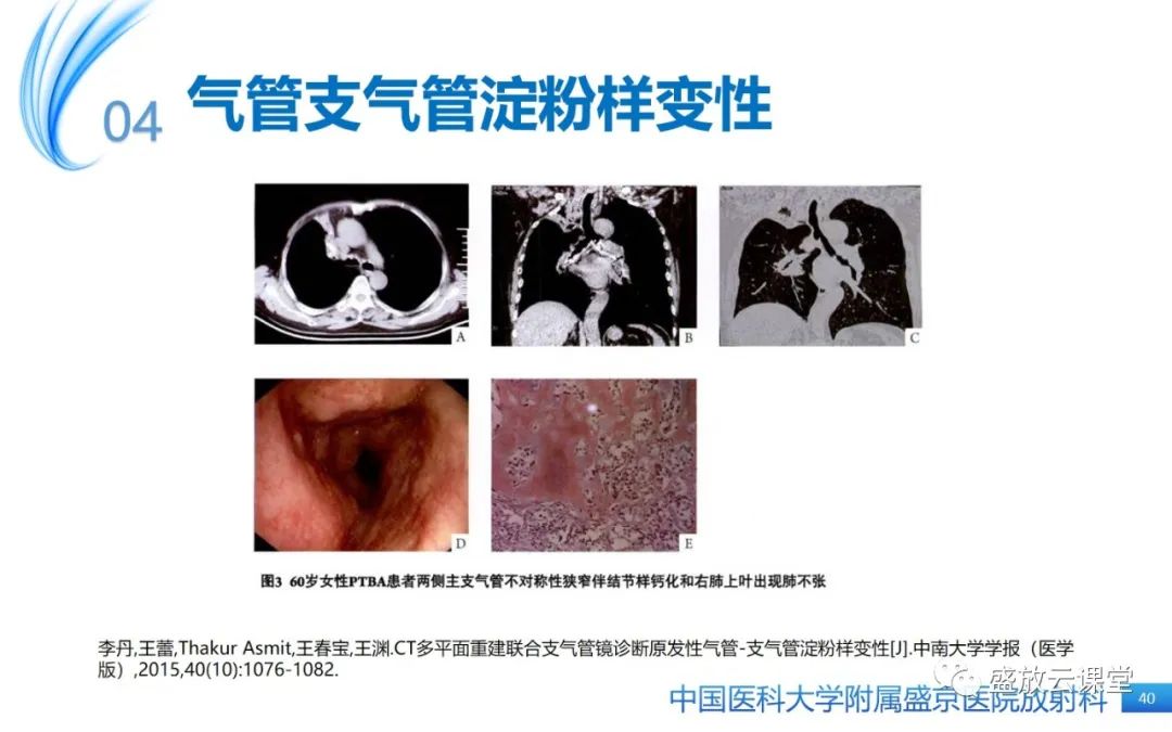 影像PPT - 【病例】弥漫性气管狭窄1例CT影像-40