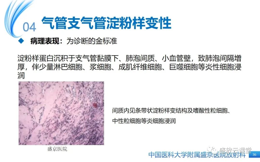 影像PPT - 【病例】弥漫性气管狭窄1例CT影像-36