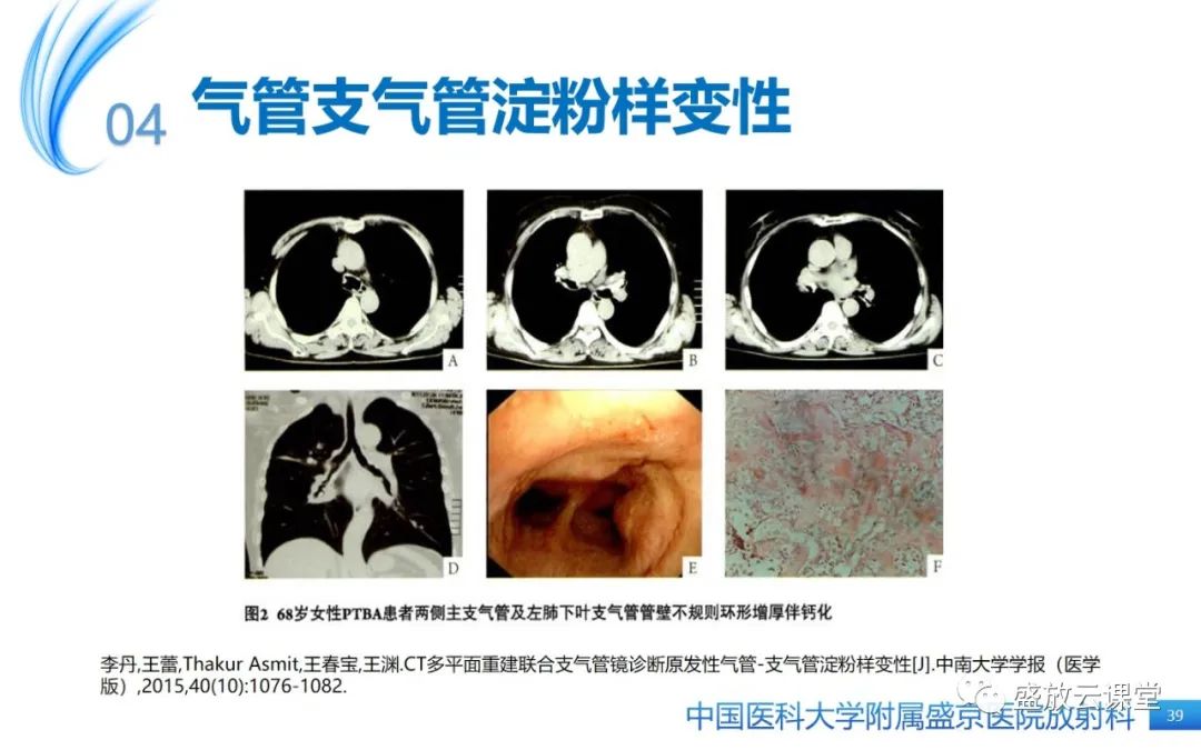 影像PPT - 【病例】弥漫性气管狭窄1例CT影像-39