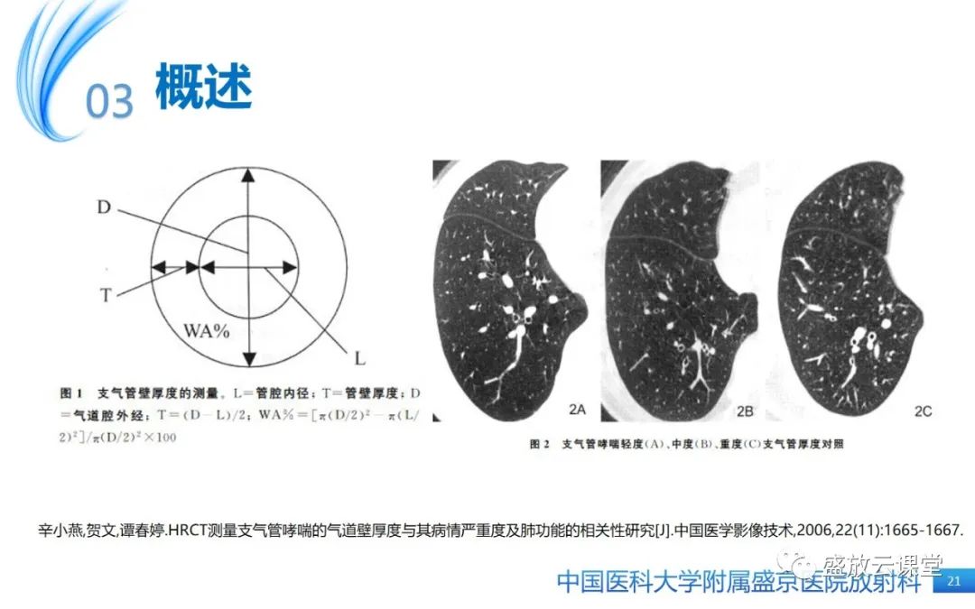 影像PPT - 【病例】弥漫性气管狭窄1例CT影像-21