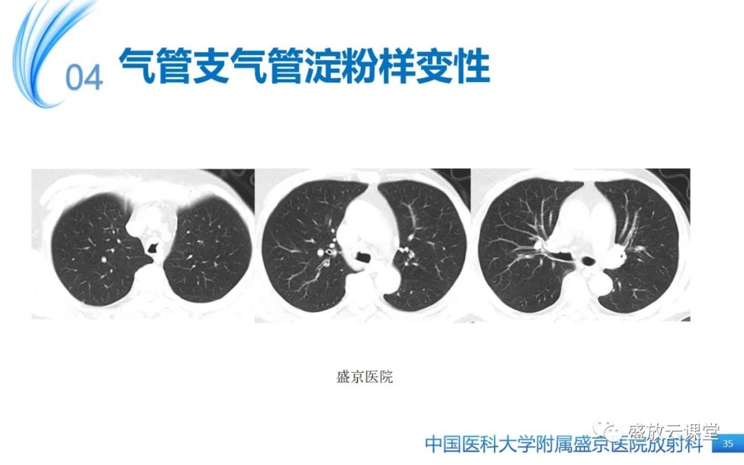 影像PPT - 【病例】弥漫性气管狭窄1例CT影像-35