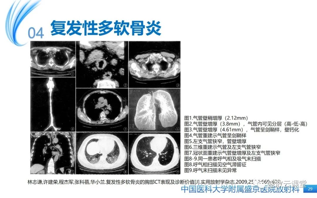 影像PPT - 【病例】弥漫性气管狭窄1例CT影像-29