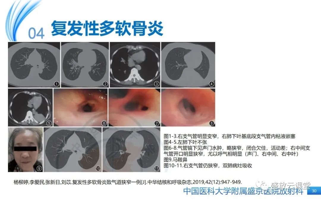 影像PPT - 【病例】弥漫性气管狭窄1例CT影像-30