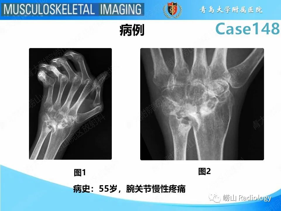 影像PPT - 【PPT】毁损性关节炎-2