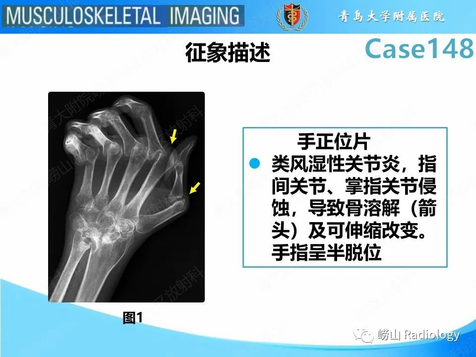 影像PPT - 【PPT】毁损性关节炎-11