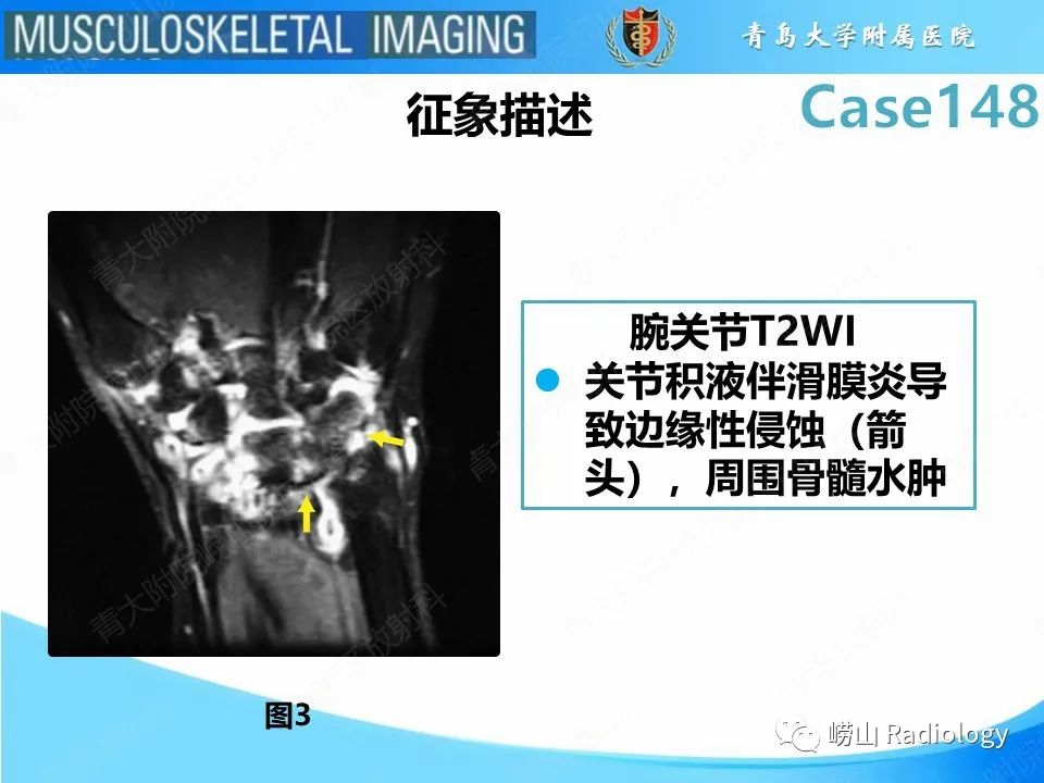 影像PPT - 【PPT】毁损性关节炎-13