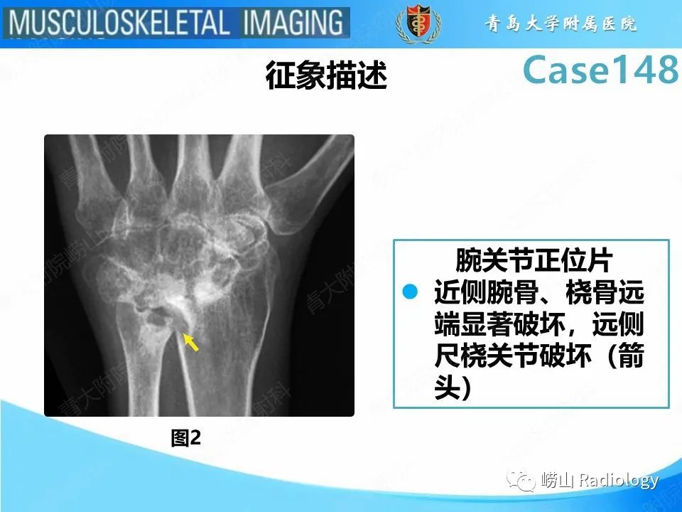 影像PPT - 【PPT】毁损性关节炎-12
