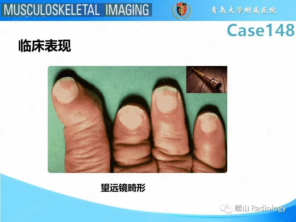 影像PPT - 【PPT】毁损性关节炎-17