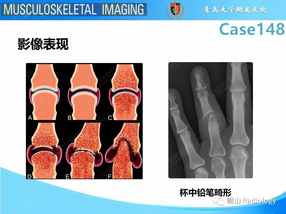 影像PPT - 【PPT】毁损性关节炎-18