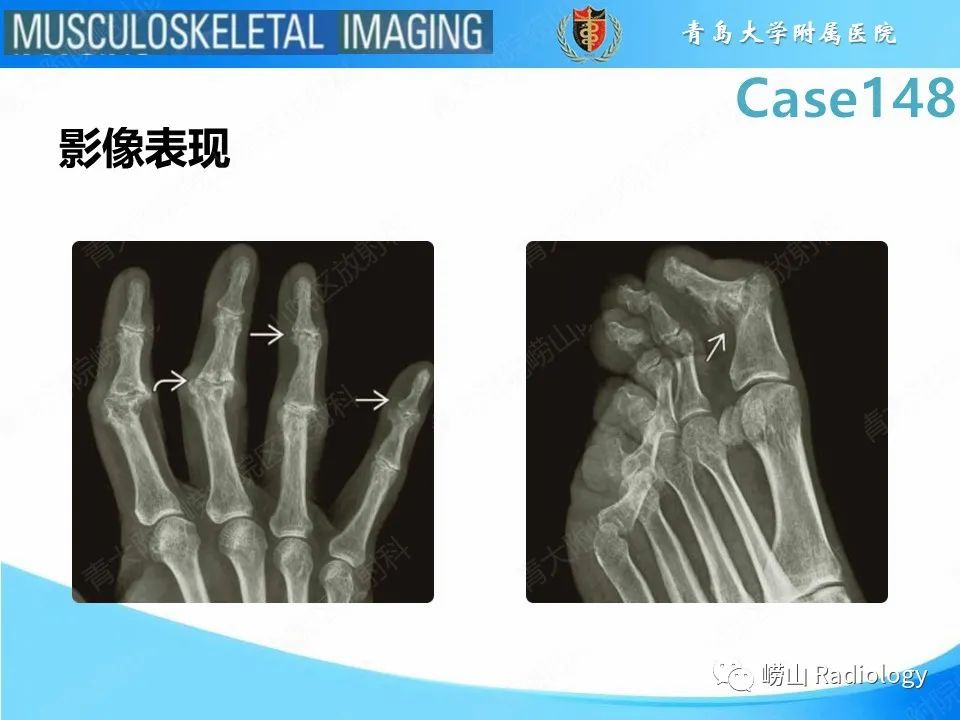 影像PPT - 【PPT】毁损性关节炎-21