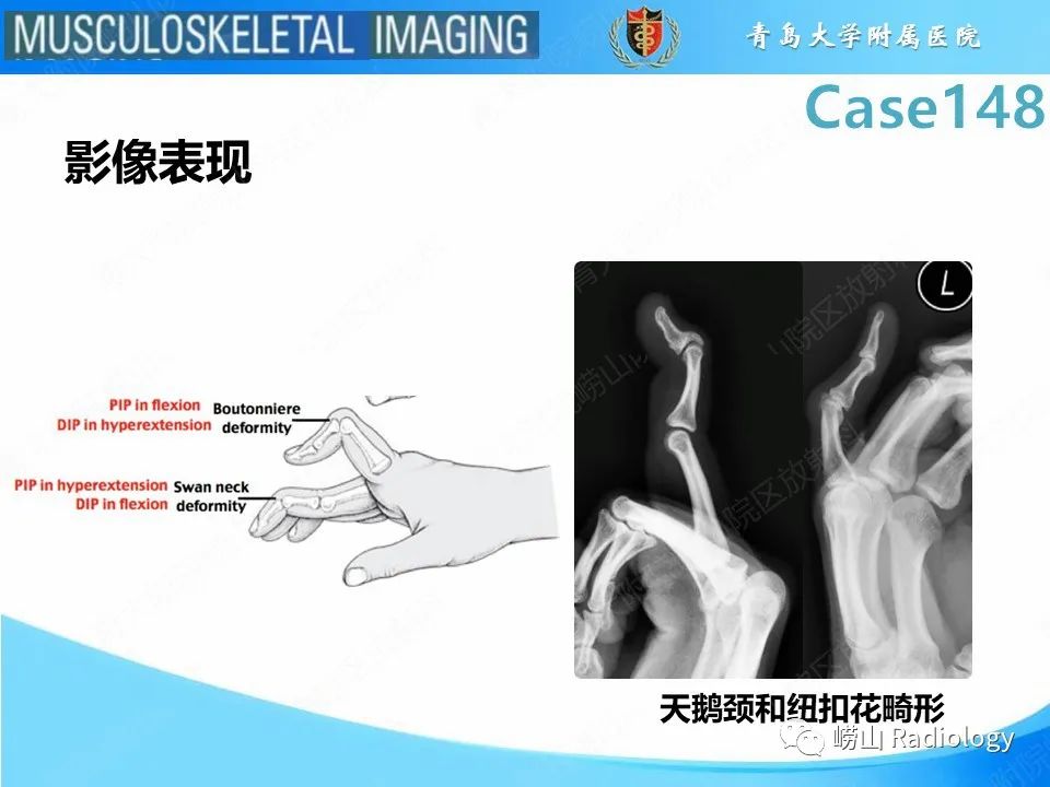 影像PPT - 【PPT】毁损性关节炎-23