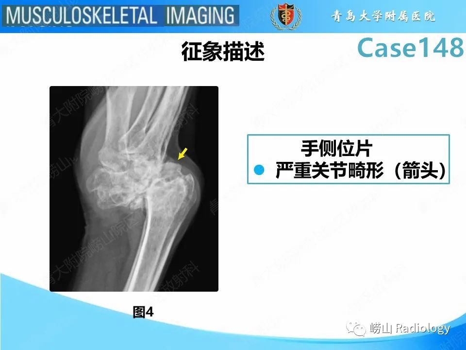 影像PPT - 【PPT】毁损性关节炎-14
