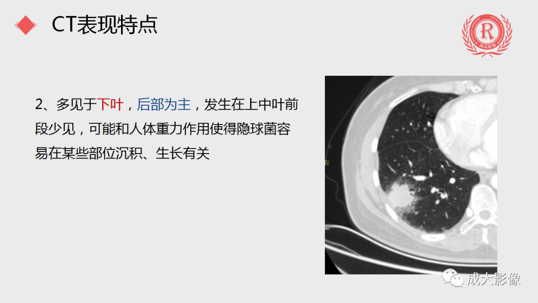 影像PPT - 【PPT】肺隐球菌病-7