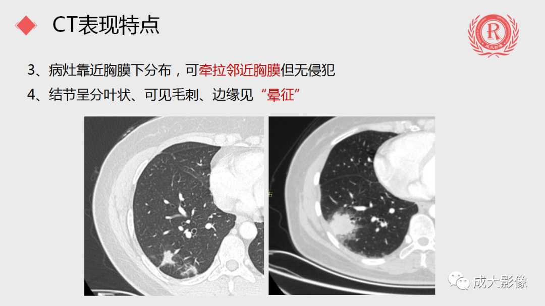 影像PPT - 【PPT】肺隐球菌病-8