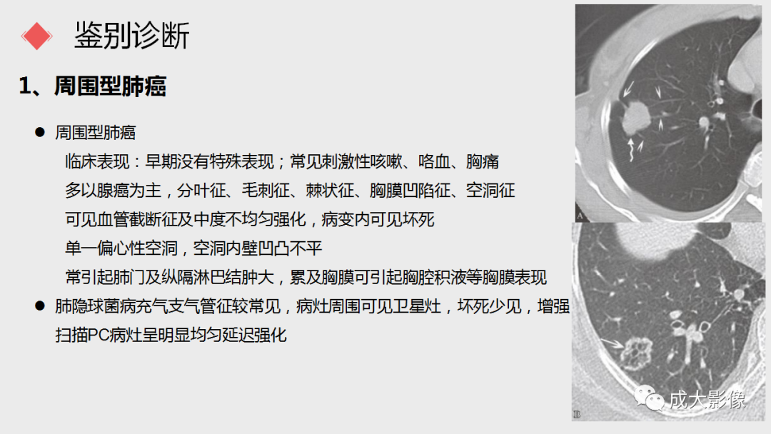 影像PPT - 【PPT】肺隐球菌病-11