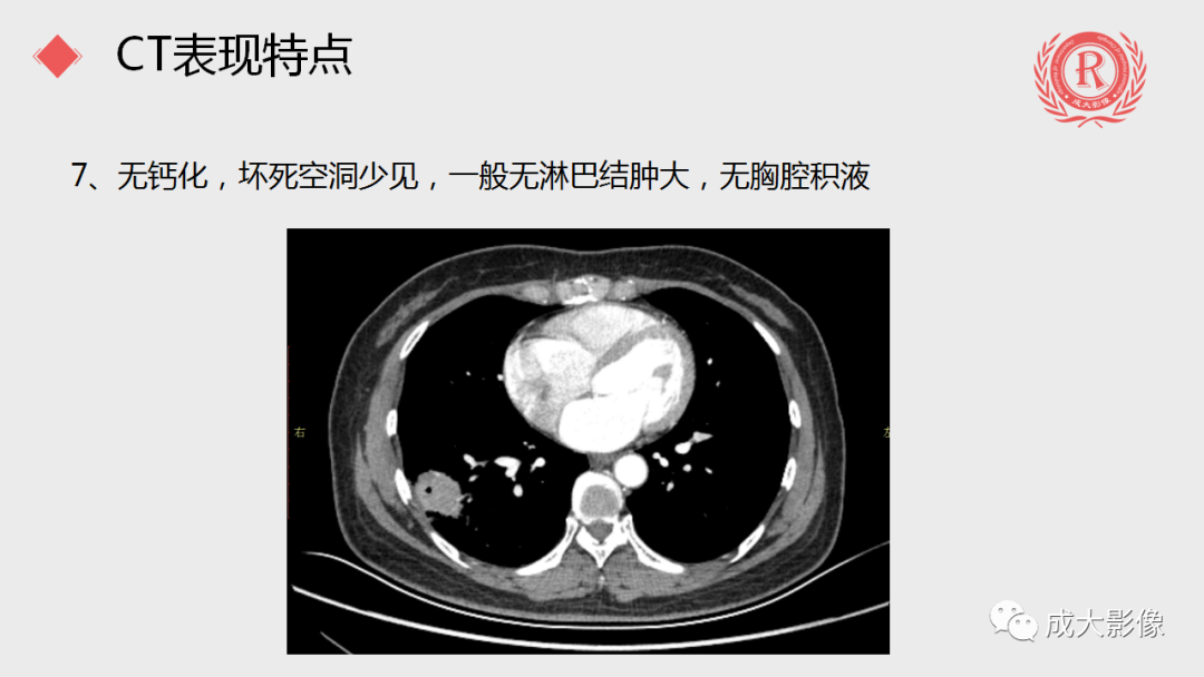 影像PPT - 【PPT】肺隐球菌病-10