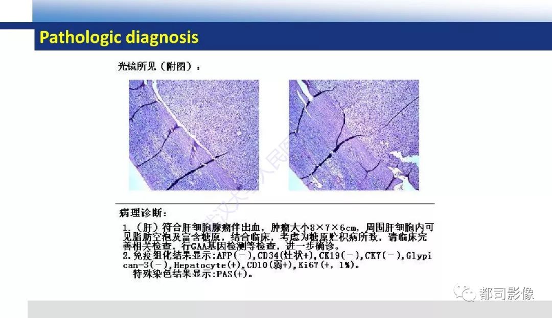 影像PPT - 【PPT】肝脏糖原累积病影像诊断-6