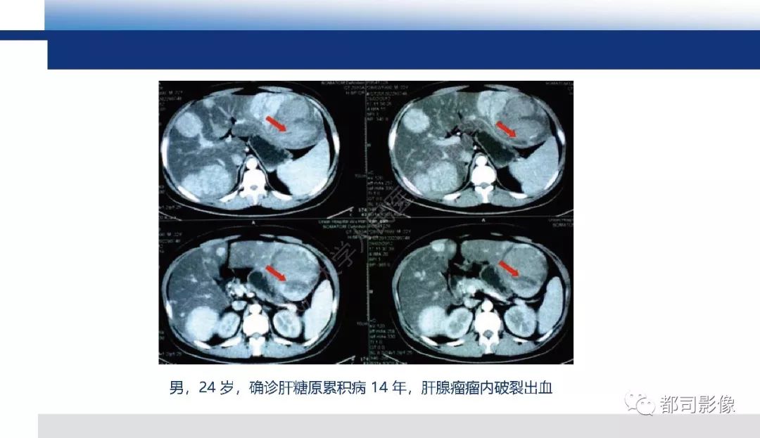 影像PPT - 【PPT】肝脏糖原累积病影像诊断-17