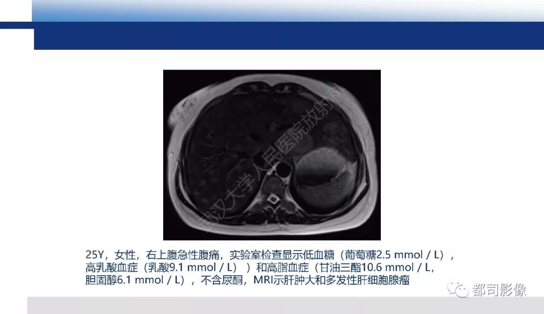 影像PPT - 【PPT】肝脏糖原累积病影像诊断-18