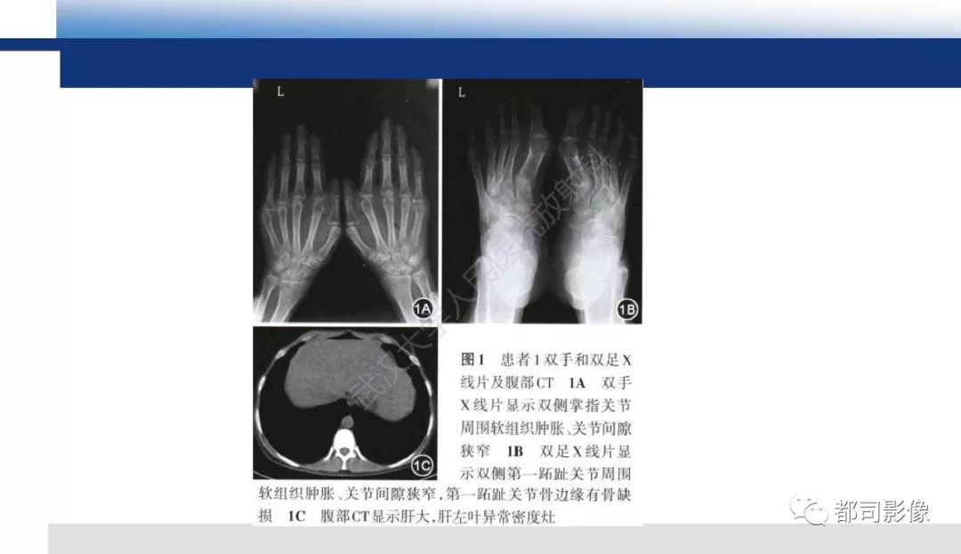 影像PPT - 【PPT】肝脏糖原累积病影像诊断-19