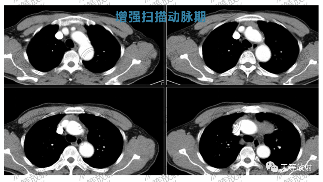 影像PPT - 【病例】胸腺非典型类癌1例CT影像-11 影像PPT - 【病例】胸腺非典型类癌1例CT影像-11