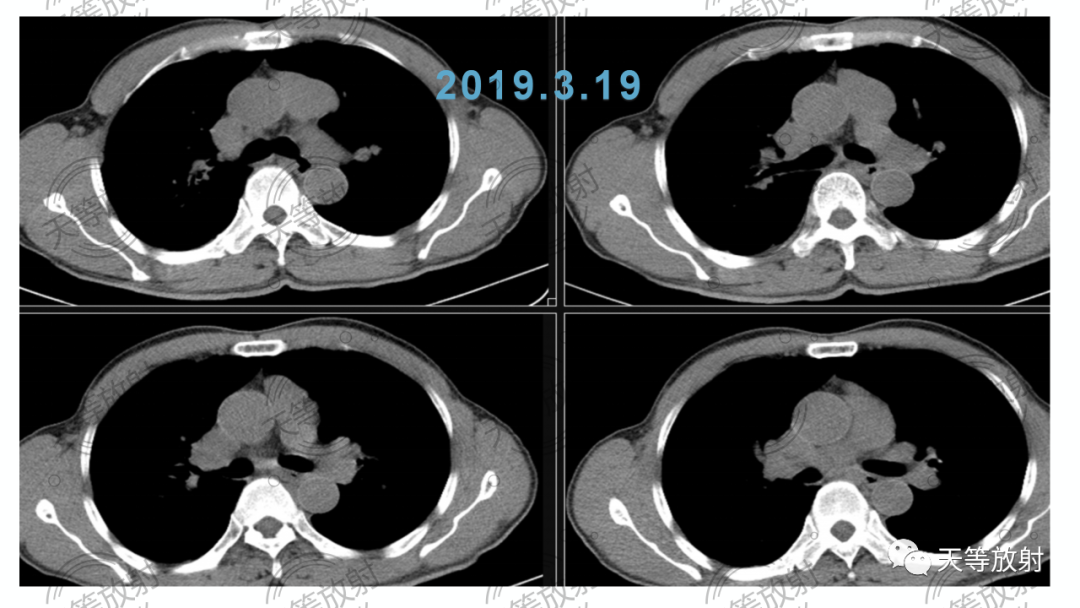 影像PPT - 【病例】胸腺非典型类癌1例CT影像-6 影像PPT - 【病例】胸腺非典型类癌1例CT影像-6