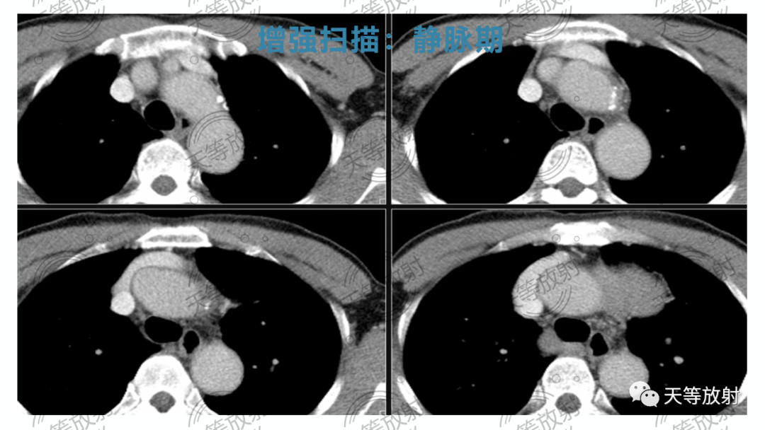 影像PPT - 【病例】胸腺非典型类癌1例CT影像-15 影像PPT - 【病例】胸腺非典型类癌1例CT影像-15