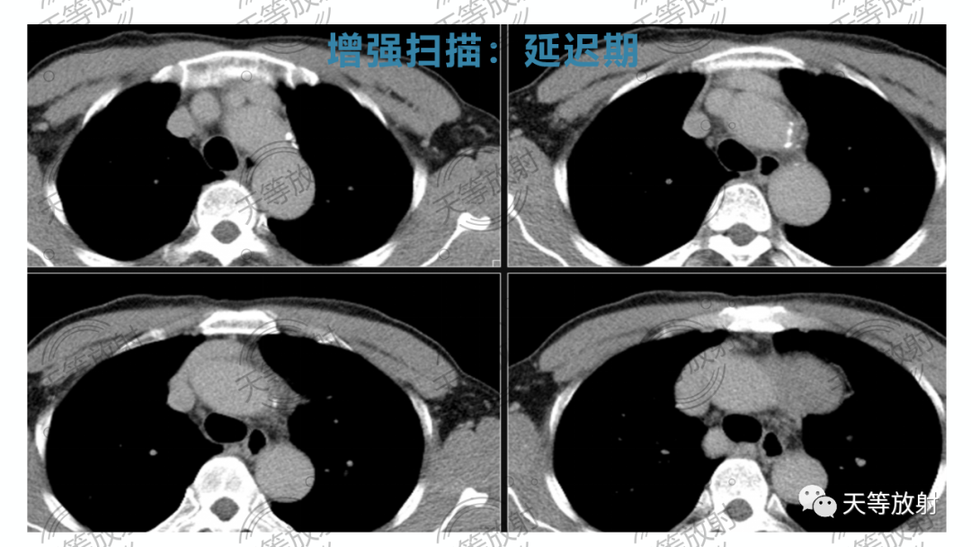 影像PPT - 【病例】胸腺非典型类癌1例CT影像-18 影像PPT - 【病例】胸腺非典型类癌1例CT影像-18