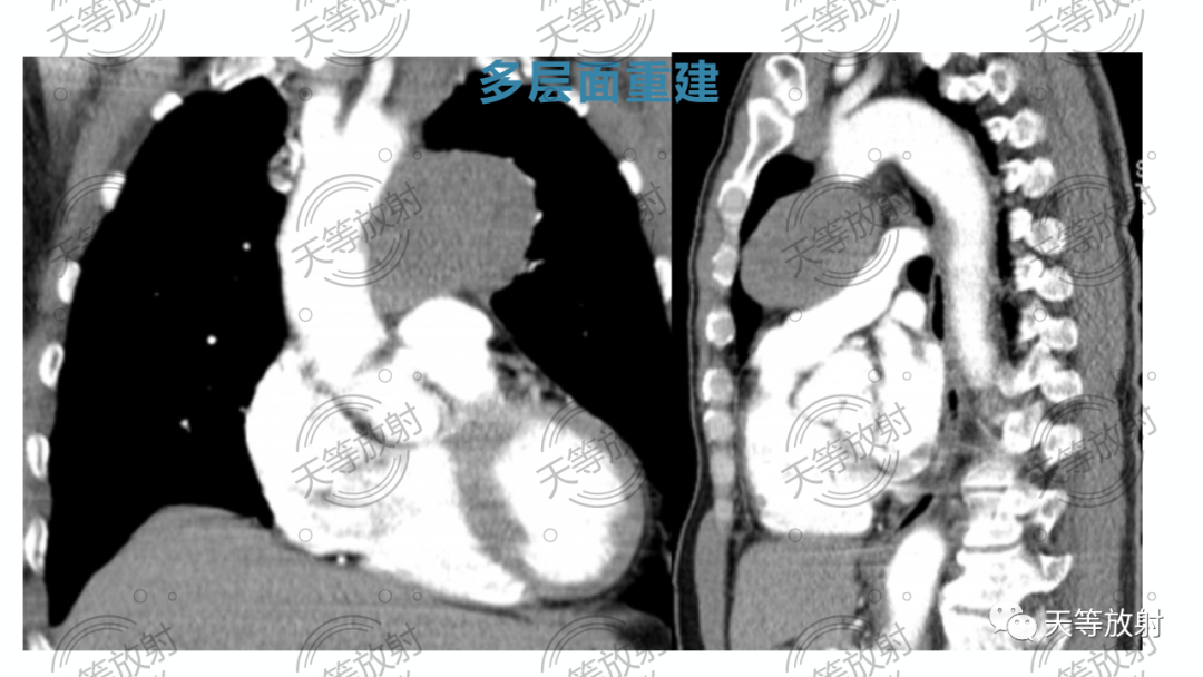 影像PPT - 【病例】胸腺非典型类癌1例CT影像-21 影像PPT - 【病例】胸腺非典型类癌1例CT影像-21
