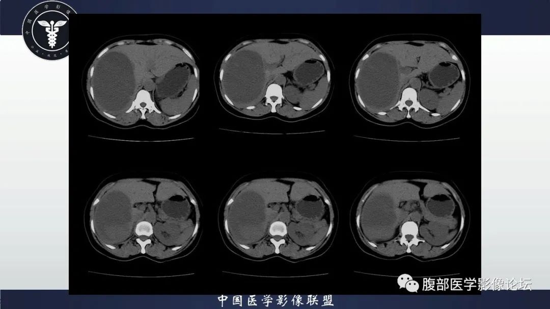 影像PPT - 【病例】肝脏未分化胚胎性肉瘤1例CT影像-4