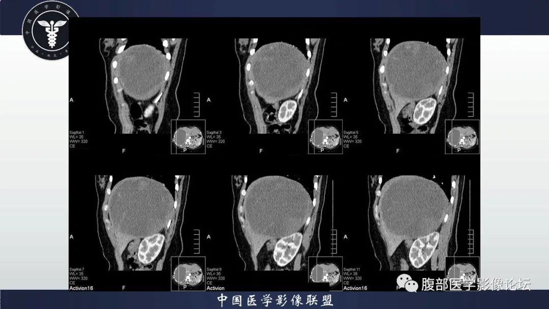 影像PPT - 【病例】肝脏未分化胚胎性肉瘤1例CT影像-11