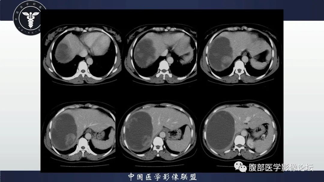 影像PPT - 【病例】肝脏未分化胚胎性肉瘤1例CT影像-7