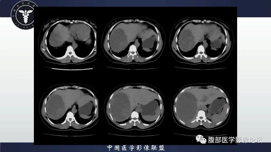 影像PPT - 【病例】肝脏未分化胚胎性肉瘤1例CT影像-3