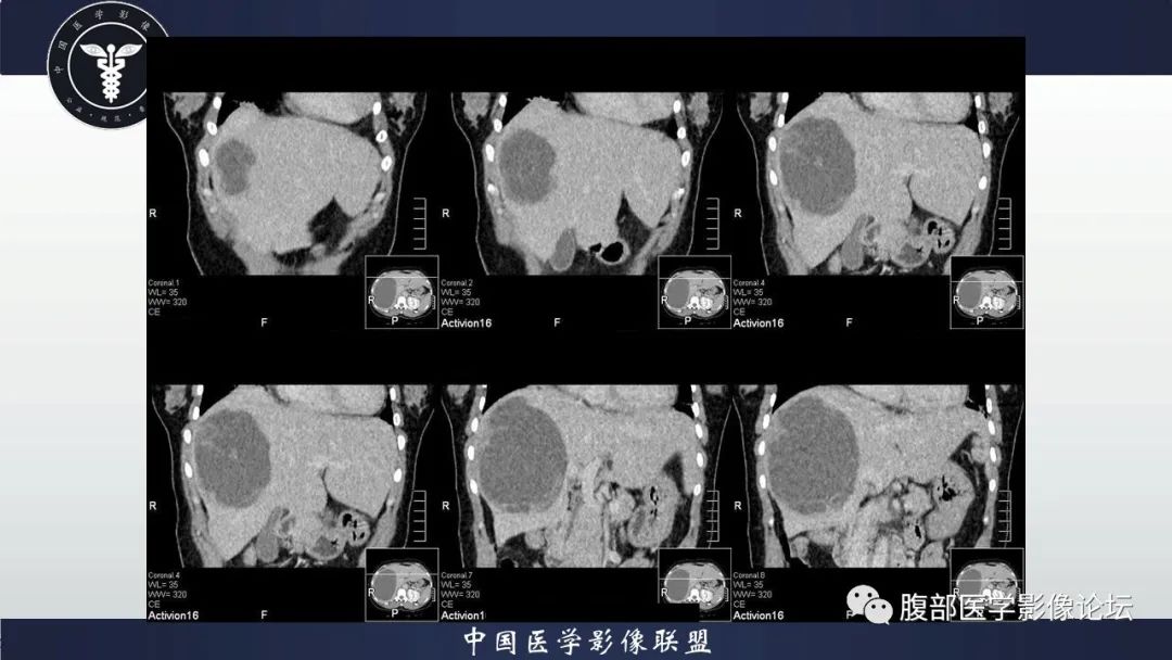 影像PPT - 【病例】肝脏未分化胚胎性肉瘤1例CT影像-13