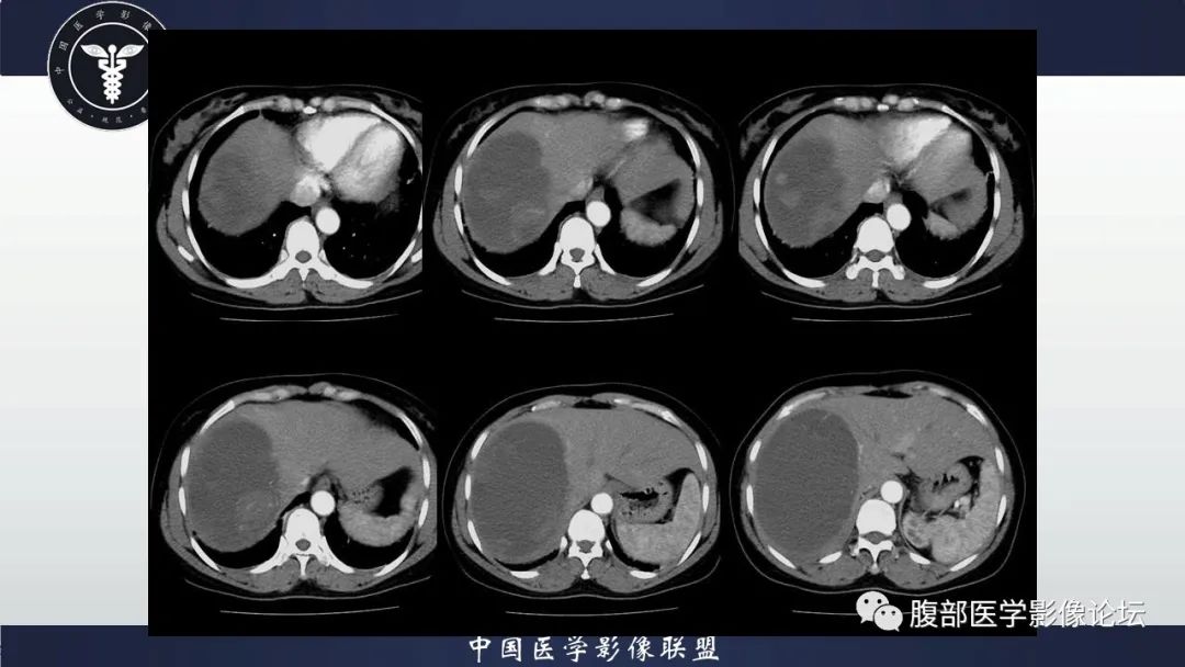 影像PPT - 【病例】肝脏未分化胚胎性肉瘤1例CT影像-5