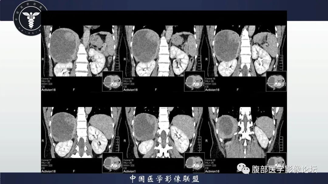 影像PPT - 【病例】肝脏未分化胚胎性肉瘤1例CT影像-15