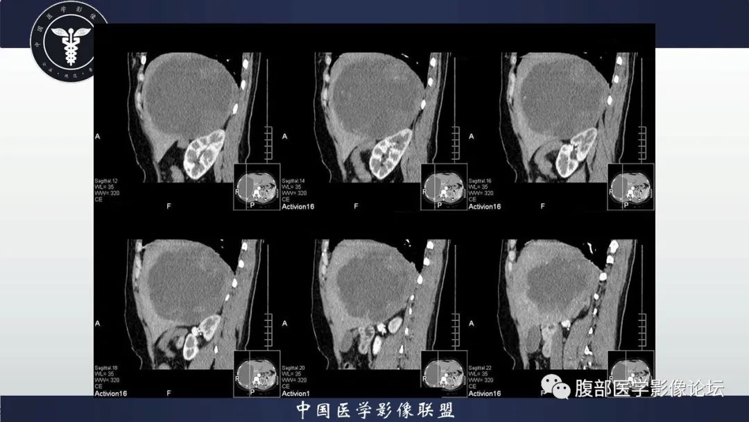 影像PPT - 【病例】肝脏未分化胚胎性肉瘤1例CT影像-12