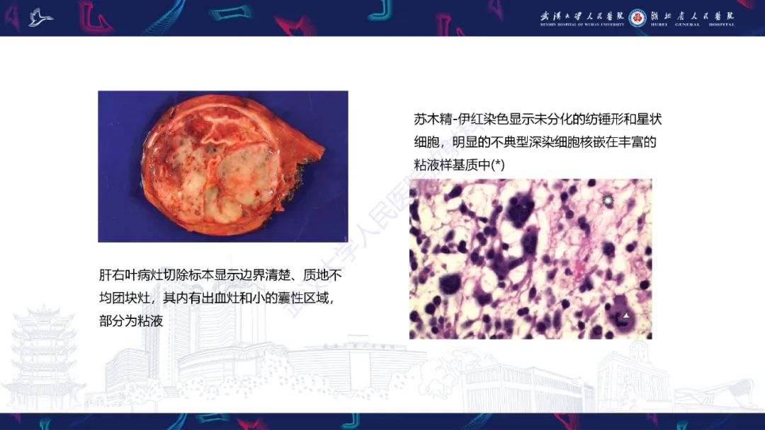 影像PPT - 【病例】肝脏未分化胚胎性肉瘤1例CT影像-25