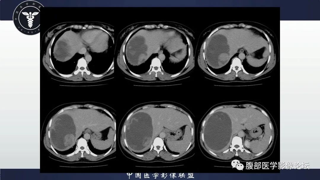 影像PPT - 【病例】肝脏未分化胚胎性肉瘤1例CT影像-9