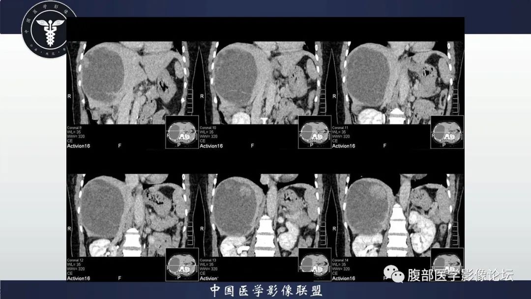 影像PPT - 【病例】肝脏未分化胚胎性肉瘤1例CT影像-14