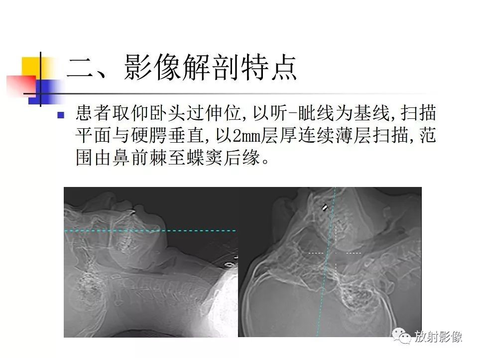 影像PPT - 【PPT】窦口-鼻道复合体影像解剖及临床意义-4