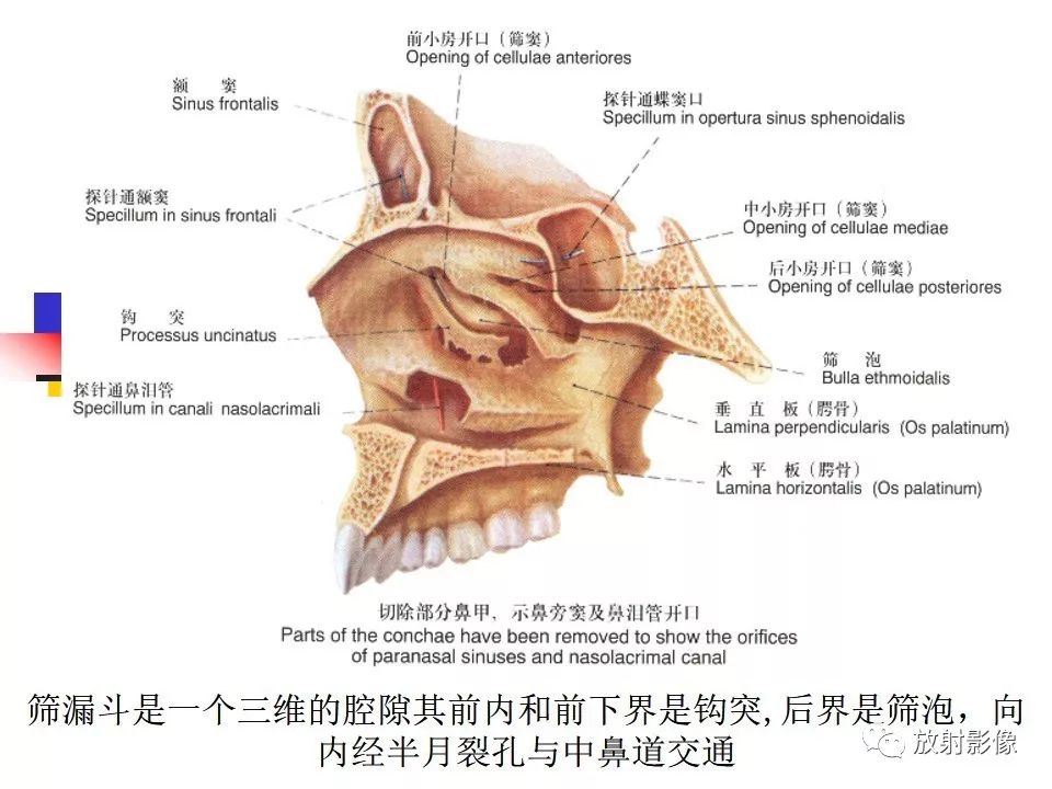 影像PPT - 【PPT】窦口-鼻道复合体影像解剖及临床意义-6