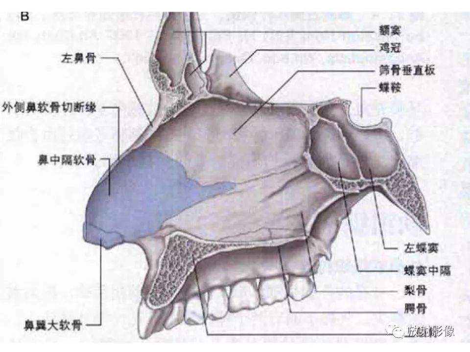 影像PPT - 【PPT】窦口-鼻道复合体影像解剖及临床意义-5
