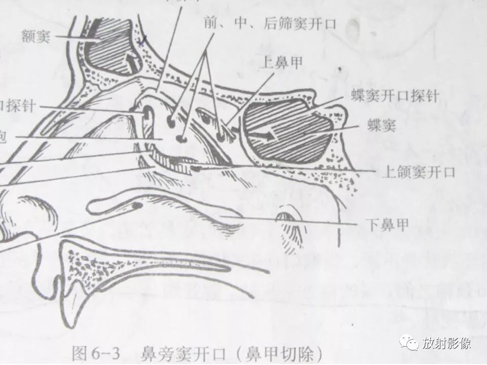 影像PPT - 【PPT】窦口-鼻道复合体影像解剖及临床意义-9