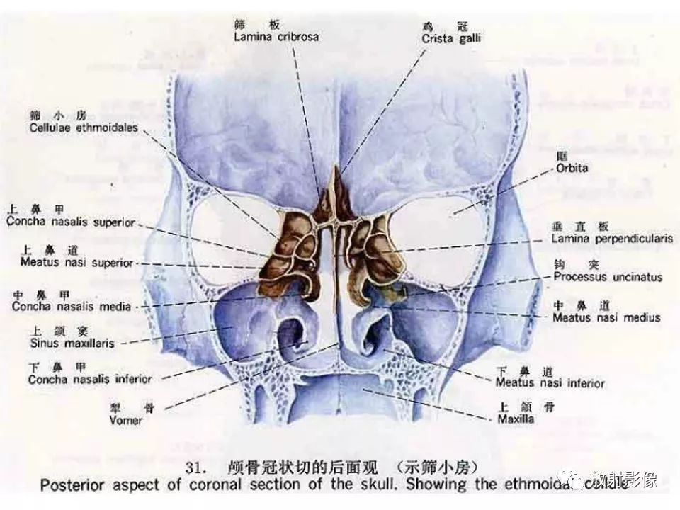 影像PPT - 【PPT】窦口-鼻道复合体影像解剖及临床意义-10
