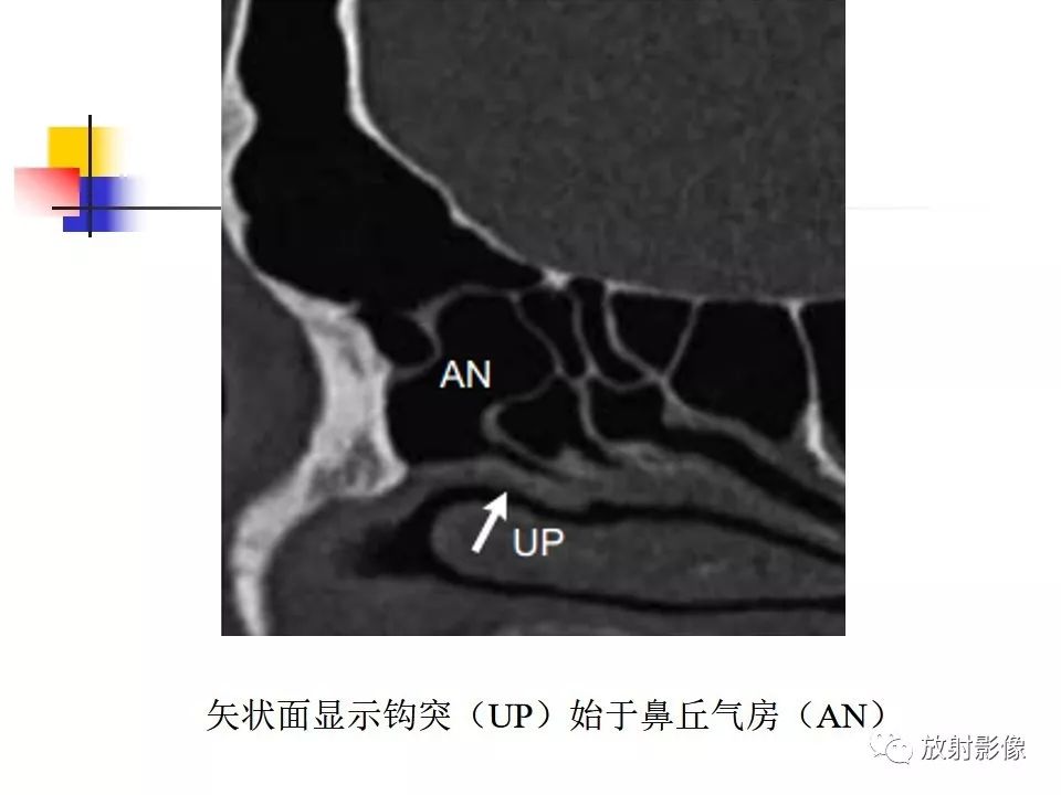 影像PPT - 【PPT】窦口-鼻道复合体影像解剖及临床意义-14